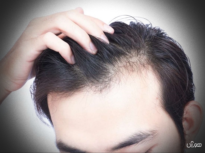 21 دلیل و علت اصلی ریزش مو در مردان و زنان
