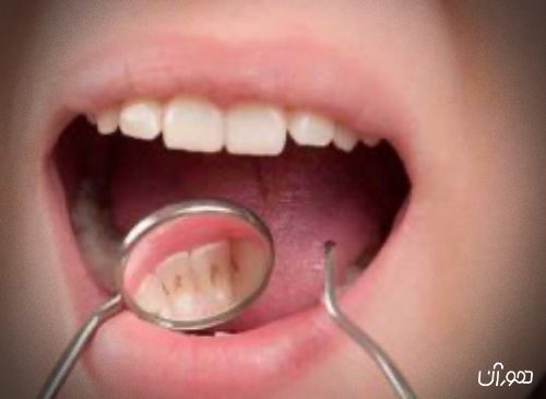 جرم ‌گیری دندان به روش‌های سنتی در خانه