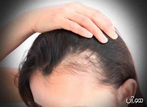 6 علت اصلی ریزش مو در زنان