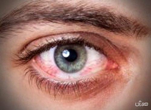 درباره سندرم خشکی چشم بیشتر بدانیم